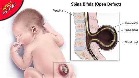 My wife and i her epidural malfunctioned halfway through the labor, and it took the anesthesiologist 3 hours to figure out what went wrong and to decide to put a new one. Baby removed from mum-to-be's womb for treatment then PUT ...