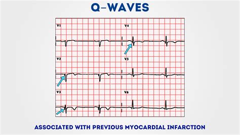 They are the result of absence of electrical activity. How to Read an ECG | ECG Interpretation | EKG | Geeky Medics