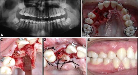 Exploratory drilling can cause the rise of pressure. Effect of surgical exposure technique, age, and grade of ...