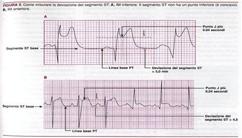 Come nel sistema venoso profondo, anche in sede come anticipato, l'embolia polmonare correlata a trombosi cardiaca o con sede nelle arterie. rachele