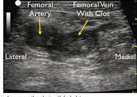 Posted on july 6, 2017 by laurenwannall. Figure 20 from The RUSH Exam 2012: Rapid Ultrasound in ...