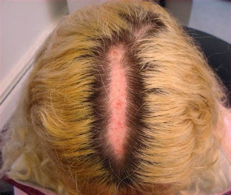 Chemical burns from hair removal creams, can be painful & leave a red rash & blisters. VIRTUAL GRAND ROUNDS IN DERMATOLOGY 2.0: Scalp Burn Post ...