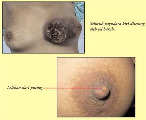 Kadangkala, kanser payudara tidak akan menunjukkan sebarang simptom hinggalah pesakit didiagnosis dengan kanser tahap 3 atau 4. b harian: Kanser Barah Payudara