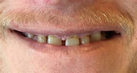 The implants themselves are tiny titanium posts that are surgically placed into the jawbone where teeth are missing. Smile Gallery - Life Smile Dental Care