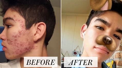 We did not find results for: E.L.F. Moisturizer Goes Viral Via Teen's Acne Routine ...