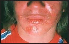 Herpes type 2 is believed to be a painful and dangerous infection that affects people. Symptoms Of Herpes In Women That You Should Know It Could ...
