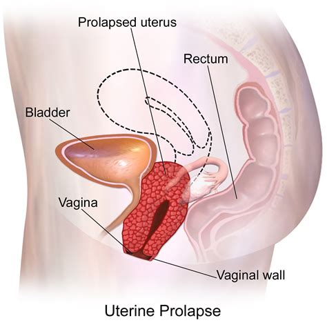 Plush & huggable with beautiful detailing. File:Uterine Prolapse.png - Wikimedia Commons