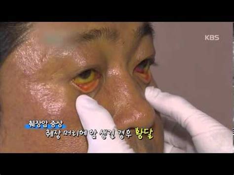 1~2년 사이 췌장암 치료 과정에서 식사 곤란으로 나타나는 전신적인 기력 저하를 1순위로 치료하고, 항암치료로 인해 무너졌던. 췌장암 회색변 — 췌장암, 췌장염에 의해서도 생길 수 있는 만큼 ...