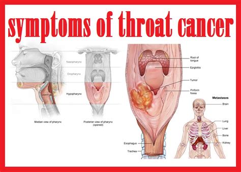 The symptoms of head and neck cancers may include a lump or a sore that does not heal, a sore throat that does not go away, difficulty in swallowing, and a change or hoarseness in the voice. throat cancer info: symptoms of throat cancer