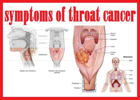 Throat cancer refers to cancer that affects the voice box, the vocal cords, and other parts of the throat that includes the tonsils and oropharynx. throat cancer info: symptoms of throat cancer