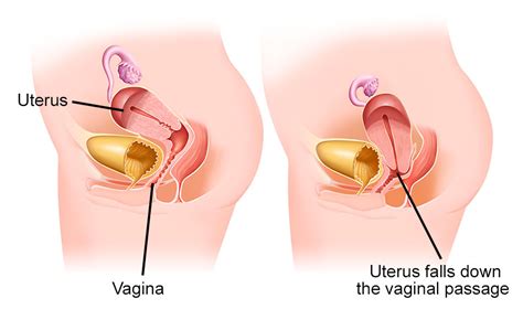 Definition uterine prolapse occurs when pelvic floor muscles and ligaments stretch and weaken the uterus then descends into the vaginal canal. Can I Have A Baby With A Prolapsed Uterus - Baby Viewer