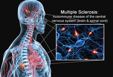 Também ocorrem perdas axonais e neuronais em graus variados. 7 fatos sobre a esclerose múltipla que você deve saber