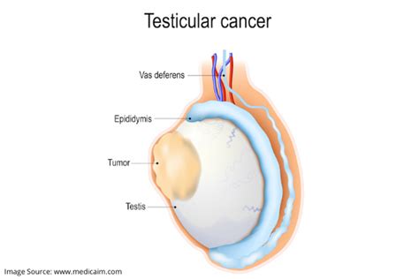 As the name goes, testicular cancer develops in the testicles, also called testes, that are a part of the male reproductive system. Signs Of Testicular Cancer