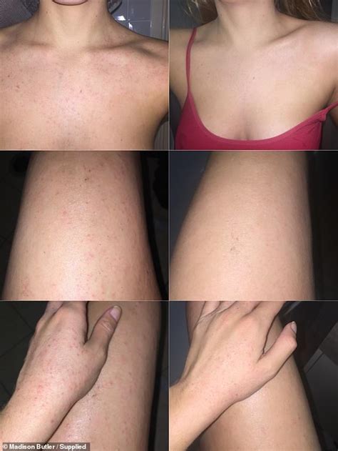 Read this article to find out all about it. Airline worker shares how MooGoo product cleared up her ...