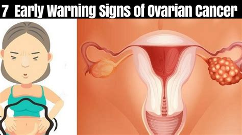 By the time a pancreatic cancer causes signs or symptoms like these, it's usually in an advanced stage. 7 Early Warning Signs of Ovarian Cancer to Never Ignore ...