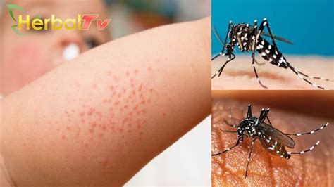 Virus ini terutama disebarkan oleh nyamuk, dan khususnya nyamuk nyamuk aedes.tanda dan gejala infeksi virus zika bisa menjadi samar dan tampak seperti banyak jenis infeksi virus lainnya. Waspada Kasus DBD Meningkat ! Ini Tanda Demam Berdarah ...