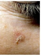 Fra le malattie autoimmuni si può menzionare anche la psoriasi, una malattia infiammatoria cronica che colpisce la pelle. Macchie rosa della pelle e cheratosi attinica: danni da ...