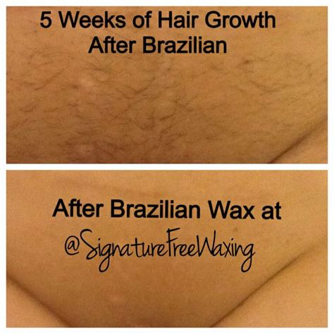 This will allow a smooth removal. Top photo: this client has a condition called PCOS which ...