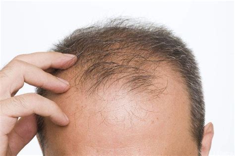 Alopecia areata is believed to be an autoimmune disease resulting from a breach in the immune privilege of the hair follicles. Alopecia, come curare la caduta dei capelli