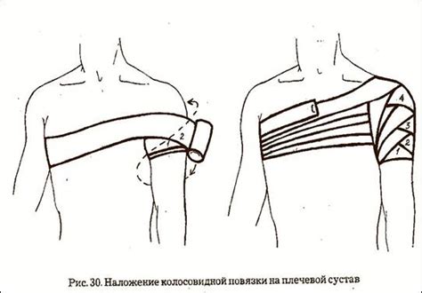 Виды изделий, их назначение, как выбрать, преимущества использования. Колосовидная повязка на плечевой сустав — Студопедия