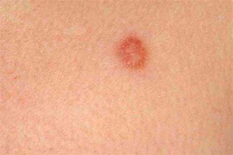 This can be done during an office visit and is called a skin biopsy. pictures of skin cancer on legs - pictures, photos