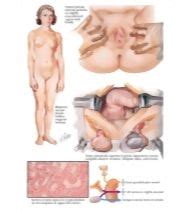 Meaning of intersex in english. Male Pseudohermaphroditism II