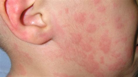 Concepto de alergias para bebés. Semana Mundial de la Alergias 2017: Causas de la Urticaria ...