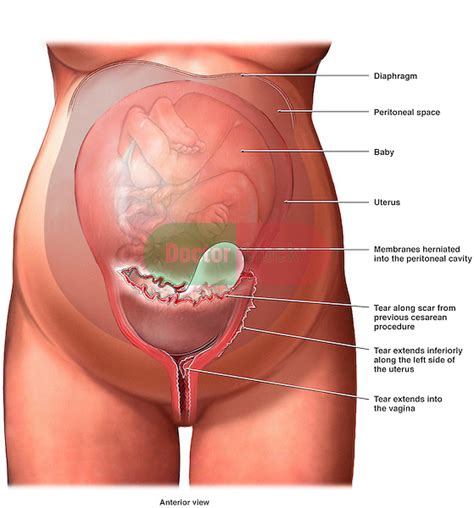 Check spelling or type a new query. Uterine Rupture During Labor | Doctor Stock