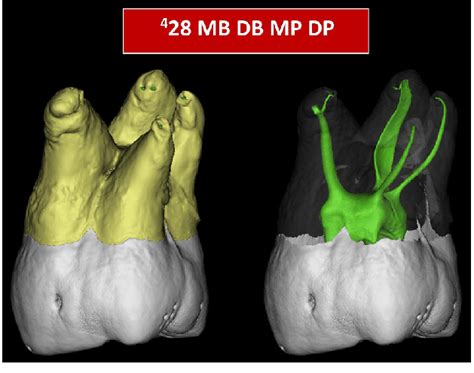 This extra cusp is usually found on the second molar, and becomes progressively less likely in the first, third molars. Application of the new coding system to describe teeth ...