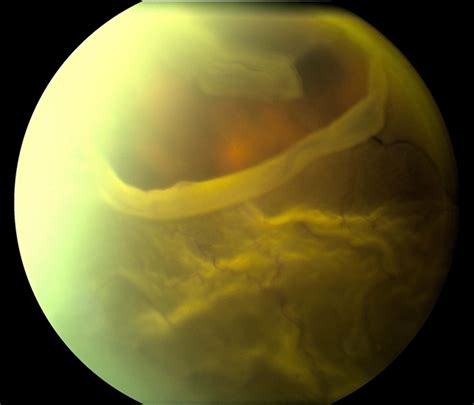 Retinal holes and tears are commonly encountered during dilated fundus examination of both symptomatic and asymptomatic patients. Large Retinal Tear - Retina Image Bank