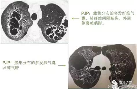 Look up in linguee suggest as a translation of 肺結核 肺結核病的CT徵象及鑑別 - 每日頭條