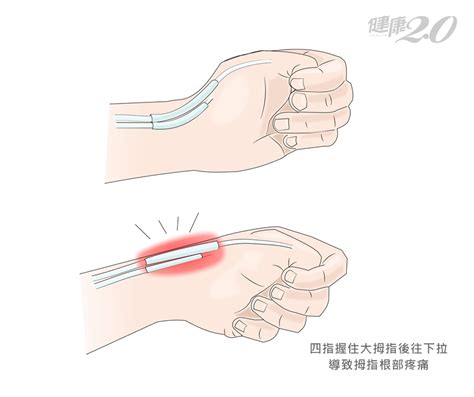 The finkelstein test is a simple test performed by your hand surgeon to help diagnose dequervain's tenosynovitis. 1個動作揪出媽媽手!復健科醫師坦言「很難痊癒」，5種治療能幫你｜健康2.0