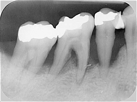 Aber was das angeht regelt. Zahnersatzplanung: Wann müssen Zähne gezogen werden?