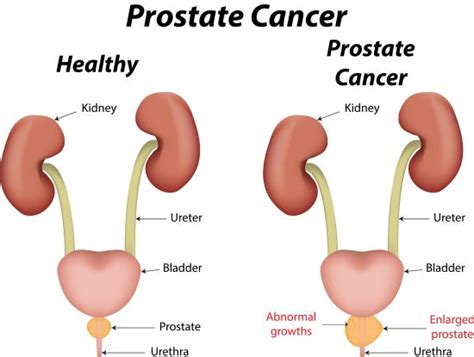 Other possible early signs of prostate cancer include unusually weak urine flow and unexplained pain around the prostate while sitting. Prostate cancer - symptoms, causes and other risk factors