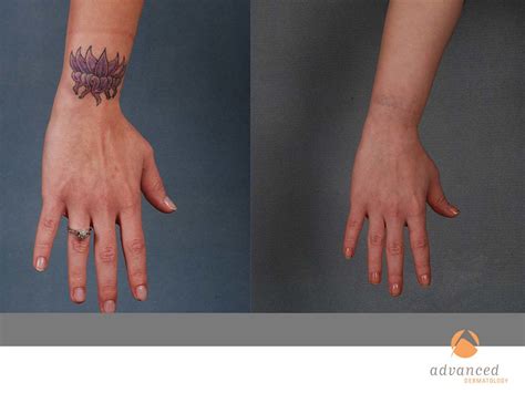 Free consultations, pain reducing techniques and flexible payment options. Laser Tattoo Removal in Chicago, IL | Advanced Dermatology