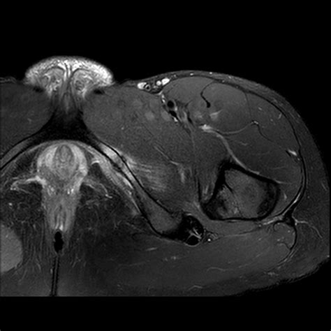 Pubic ramus stress fracture | Image | Radiopaedia.org
