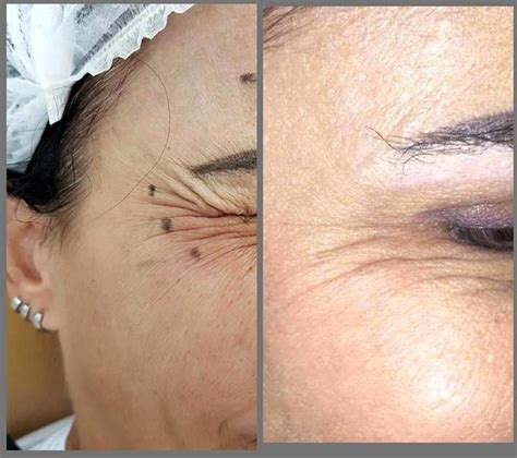 Dysport is slightly more affordable, with realself showing a national average dysport cost of $450 per session. A Candidate For Botox Crow's Feet » Facial Injections ...