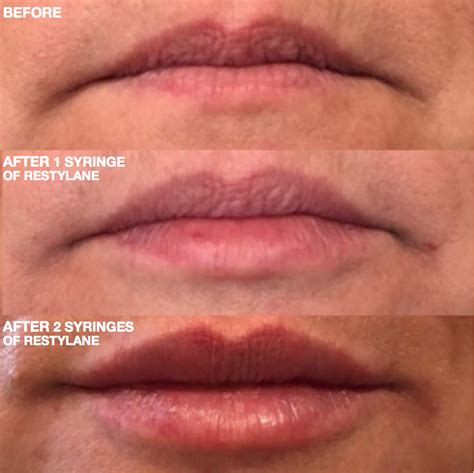 Achieve a fuller look with our safe & effective lip enhancements! Restylane lip filler before and after