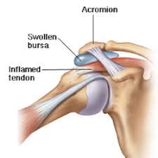 It is common, treatable, and often heals within months. Help - I've got shoulder bursitis! - The Physio Depot