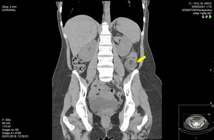What do you prefer to learn with? A rare case of adult colocolonic intussusception of the ...