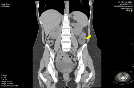 Ileocolic anastomosis done.such anastomosis relies on the marginal artery of drummond. A rare case of adult colocolonic intussusception of the ...