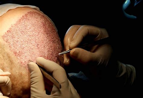 Usually, after your hair transplant surgery, your scalp may become swollen or slightly inflamed around the incisions. Hair transplant in Istanbul | Beauty Travels 24