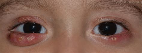 Anyone can a get a chalazion, but they are more common in people with an underlying skin condition. Chalazia