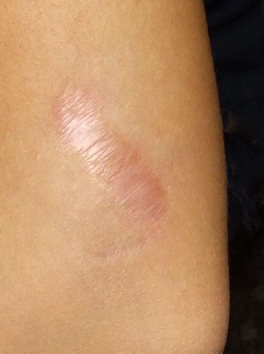Read about keloids, which are tough, irregularly shaped scars that progressively enlarge. Confessions Of A Beauty Addict: Xeragel Ointment - A Review
