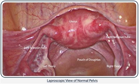 In this hysteroscopy procedure video you will see the view of a normal uterus from inside the uterus. What is Laparoscopy