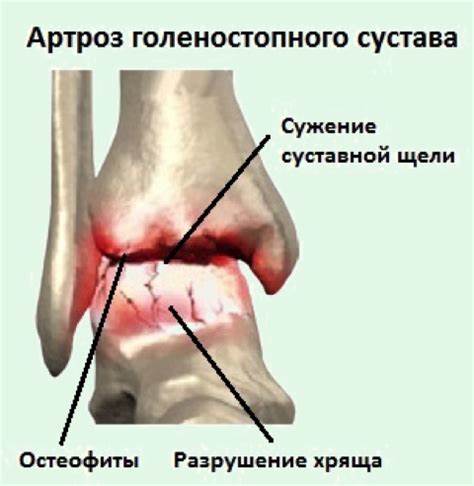 Артроз голеностопного сустава диета