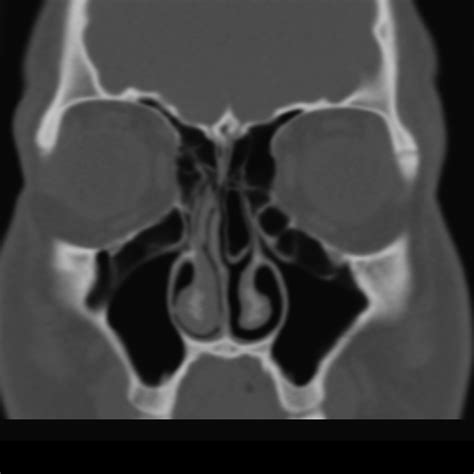 The cells are variable in both size and number in the lateral mass of each of the ethmoid bones and cannot be palpated during an extraoral examination. Haller cells - extensive | Image | Radiopaedia.org