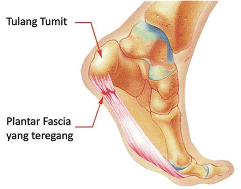 Sebenarnya, rasa nyeri pada tulang kaki ini bukan muncul tanpa adanya sebab. Catatan Ibunda: NYERI DI TELAPAK KAKI