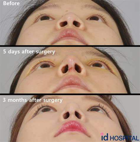 Maybe you would like to learn more about one of these? Do people notice rhinoplasty/nose job? - Quora