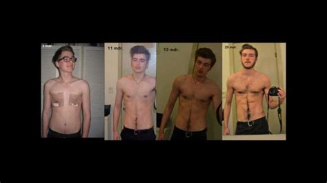 See more ideas about female to male surgery, trans man, transgender. ftm+pictures | Transgender FTM Bottom Surgery | The T ...